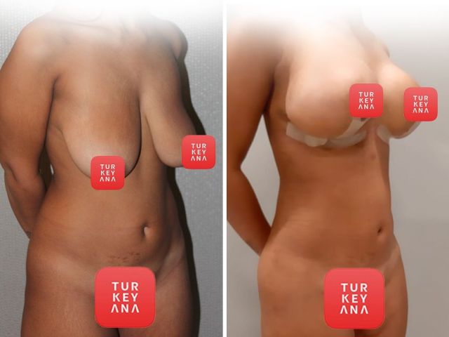 An image showcasing the Plastic Surgery or Cosmetic Surgery package, provided by Turkeyana clinic An image showcasing the Plastic Surgery or Cosmetic Surgery package, provided by Turkeyana clinic