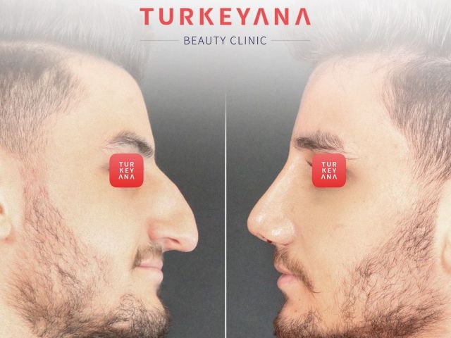 An image showcasing the Nose Surgery / Rhinoplasty package, provided by Turkeyana clinic An image showcasing the Nose Surgery / Rhinoplasty package, provided by Turkeyana clinic