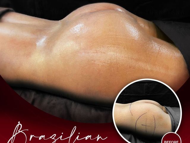 An image showcasing the Buttock Lift or BBL package, provided by Turkeyana clinic An image showcasing the Buttock Lift or BBL package, provided by Turkeyana clinic