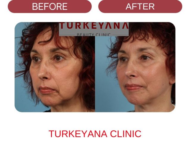 An image showcasing the Face Lift package, provided by Turkeyana clinic An image showcasing the Face Lift package, provided by Turkeyana clinic