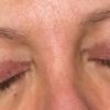 Eyelid Surgery